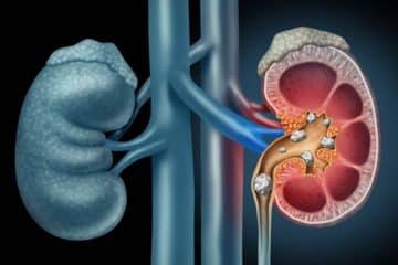 kidney stones treatment
