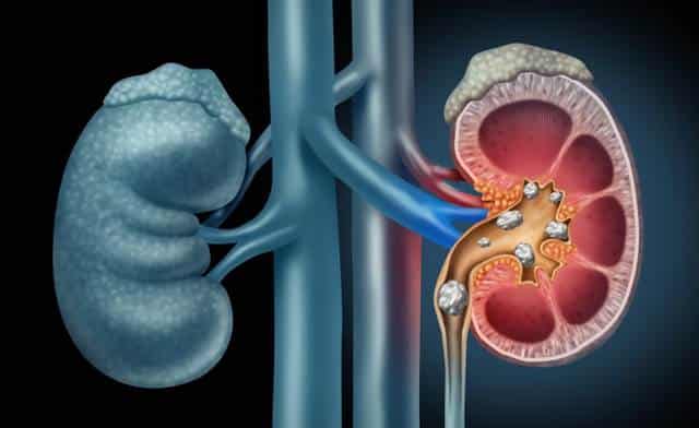 kidney stones treatment