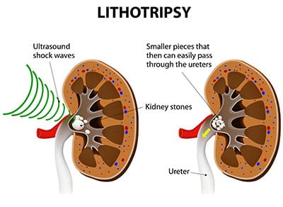 lithotripsy