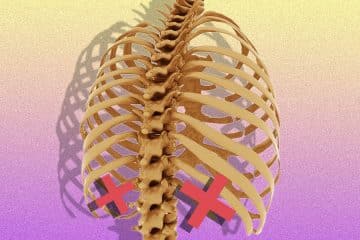 Rib Removal Surgery Cost