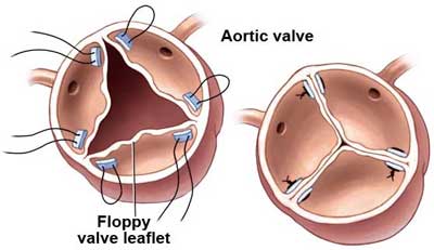 aortic valave repair