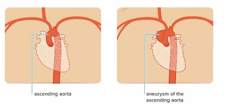 ascending aorta aneurysm