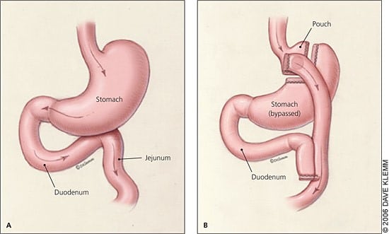Bariatric Surgery Cost - Gastric Bypass Surgery