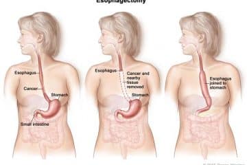 esophagectomy