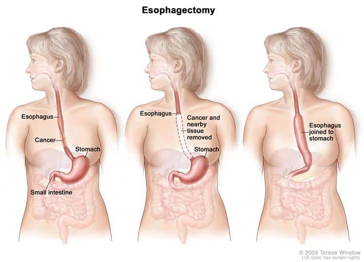 esophagectomy