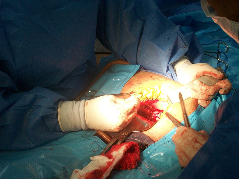 Suturing of the uterus after extraction