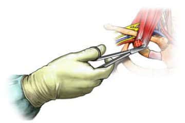 scalenectomy