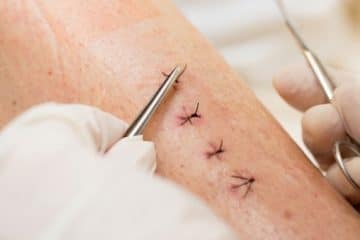 Sutured wound