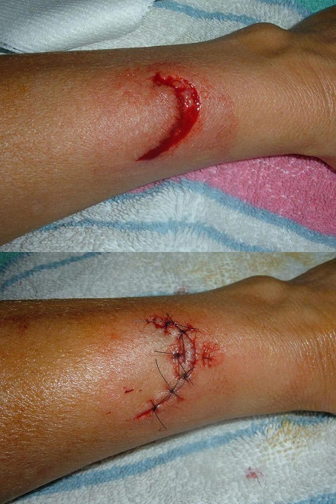 sutured wound with simple interrupted stitches and vertical mattress in the middle