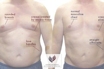 Gynecomastia Surgery | Male Breast Reduction