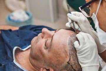 hair transplant surgery