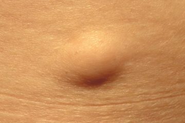 lipoma removal cost