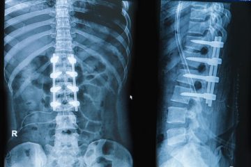 spine fusion surgery