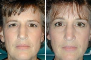 forehead lift recovery pictures