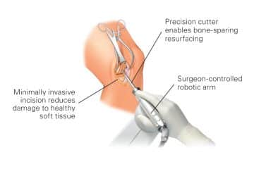 patella surgery