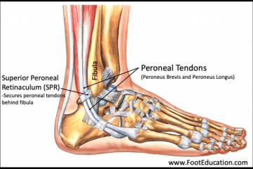 Peroneal Tendon Subluxation Surgery