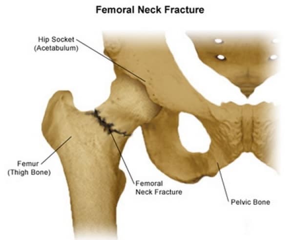 Types of Hip Fractures