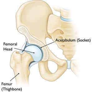 Types of Hip Fractures