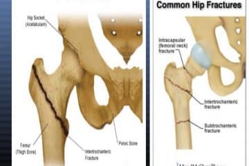 Types of Hip Fractures