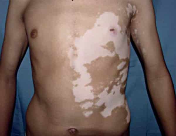 segmental vitiligo