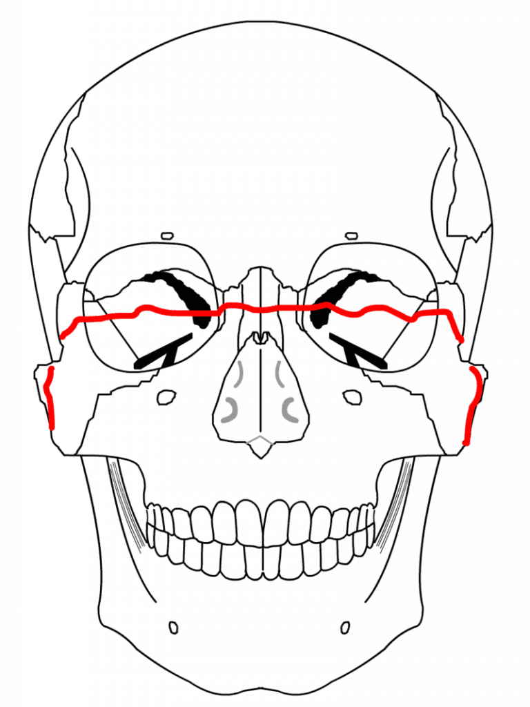 Le Fort III fracture