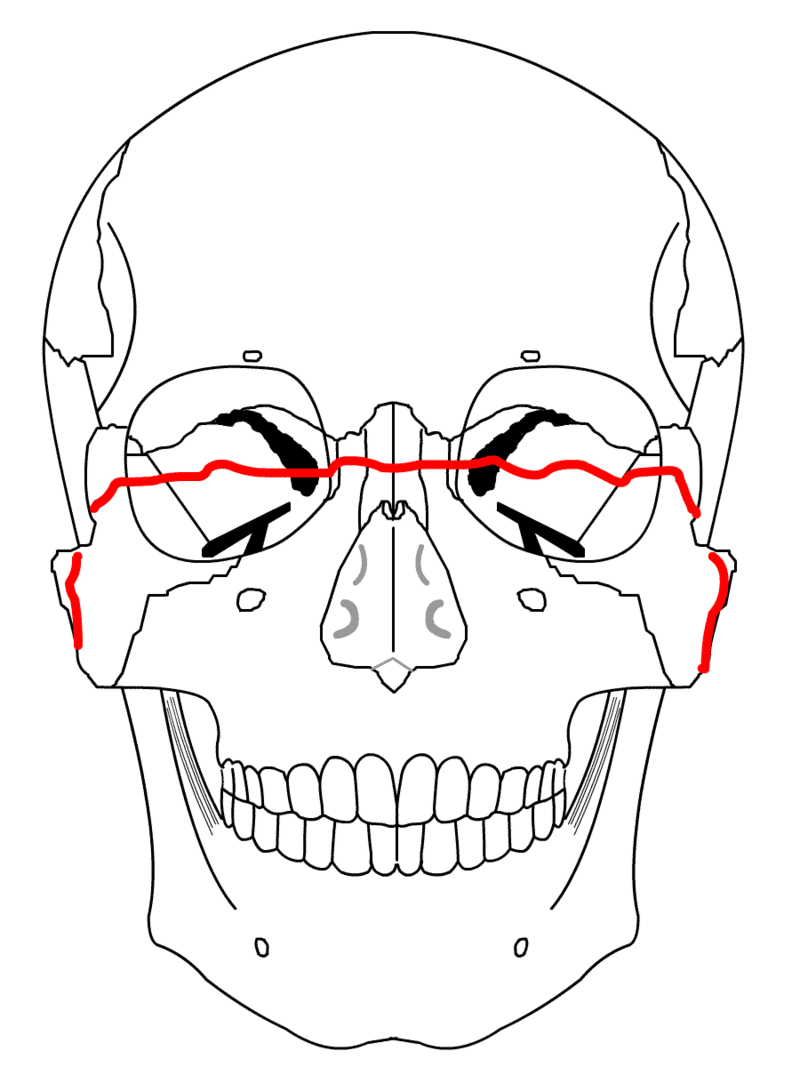 ranking of le fort fracture ranking of le fort fracture