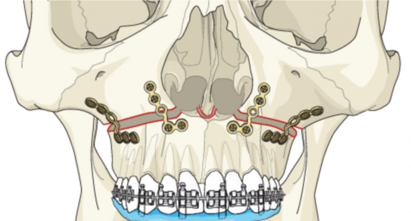 Le Fort Osteotomies Le Fort Osteotomy I, II, III Cost