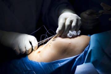 Meniscus Surgery Cost