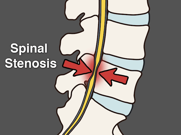 spinal stenosis