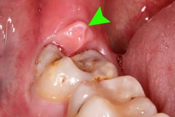 Operculectomy Cost