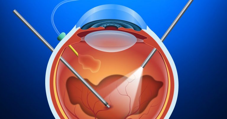 Vitrectomy Indications Procedure Cost Sutured vitrectomy-indications-procedure-cost-sutured