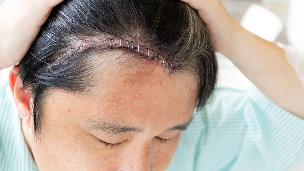Craniotomy procedure recovery cost sutured