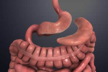 Sleeve Gastrectomy Surgery