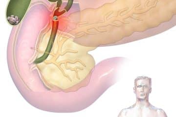gallbladder surgery recovery time