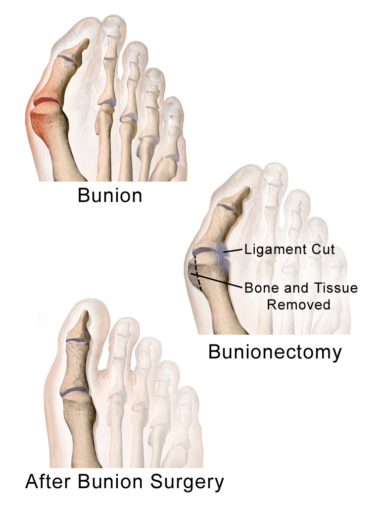 Bunion Surgery | Cost | Indications | procedure