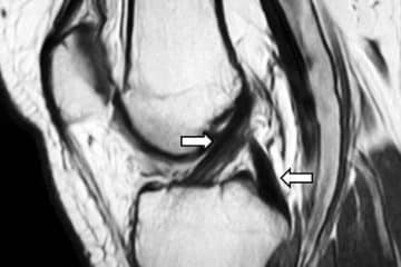ACL Reconstruction Surgery