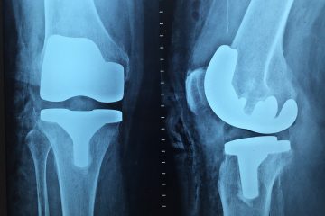 Orthopedic Surgery Types