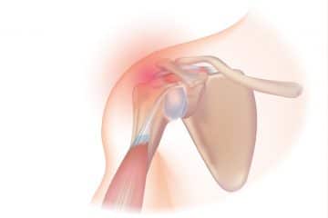 Rotator Cuff Surgery