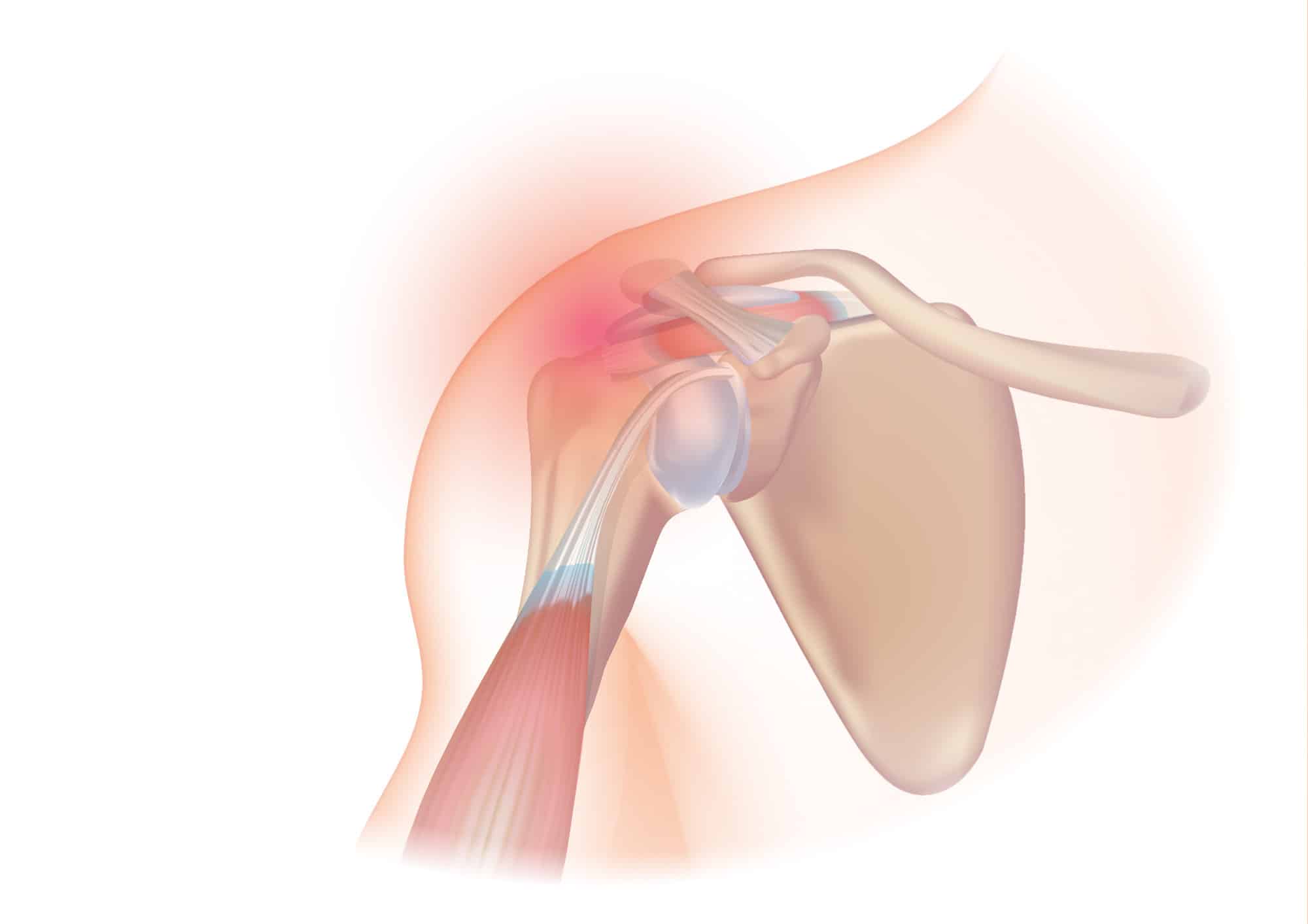 Rotator Cuff Surgery Overview Cost Performance Sutured