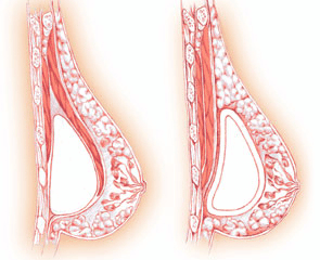 Breast Augmentation Surgery