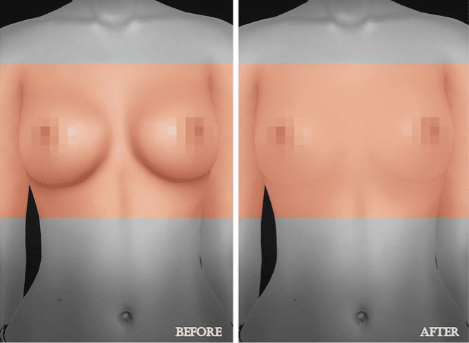 Breast Augmentation Surgery