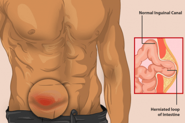 Emergency Hernia Surgery