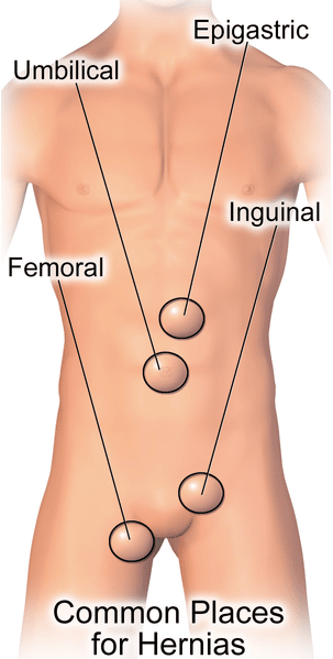 Emergency Hernia Surgery