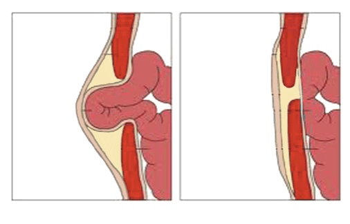 Emergency Hernia Surgery