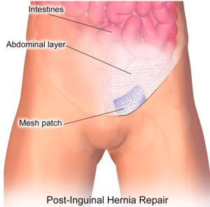 Emergency Hernia Surgery