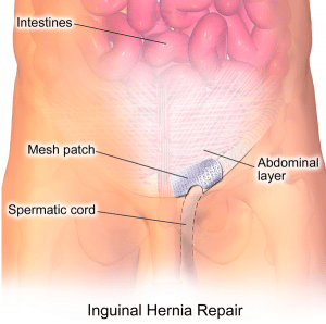 Emergency Hernia Surgery