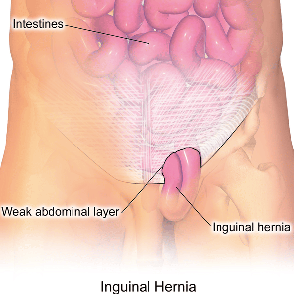 Emergency Hernia Surgery