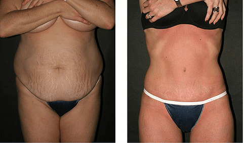 Can a Mommy Makeover Reduce My Stretch Marks?