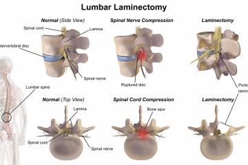 Foraminotomy Surgery