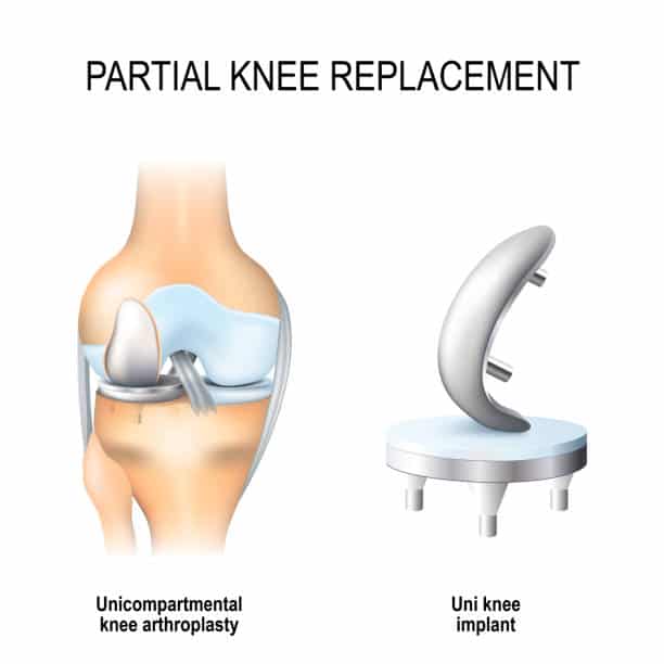 Partial Knee Replacement